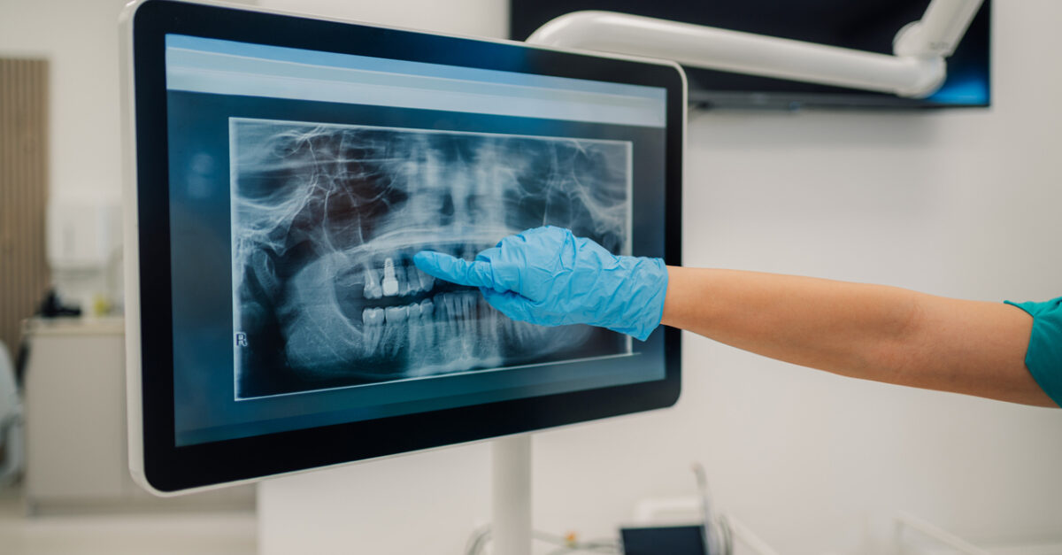 TMJ Imaging (Temporomandibular Joint) Scans Sydney - Advicon Imaging