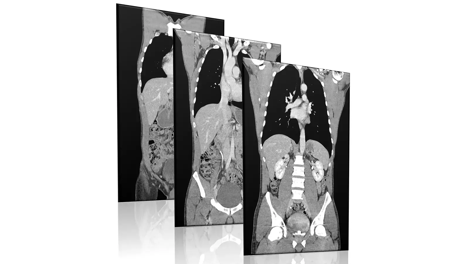 Combined CT scan of the chest, abdomen and pelvis