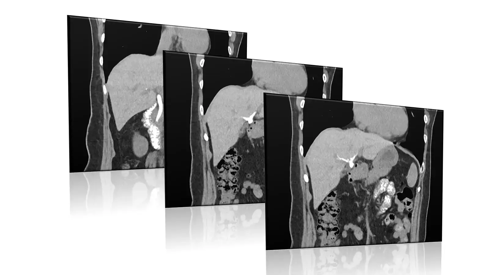 CT cholangiogram image showing the bile ducts and liver