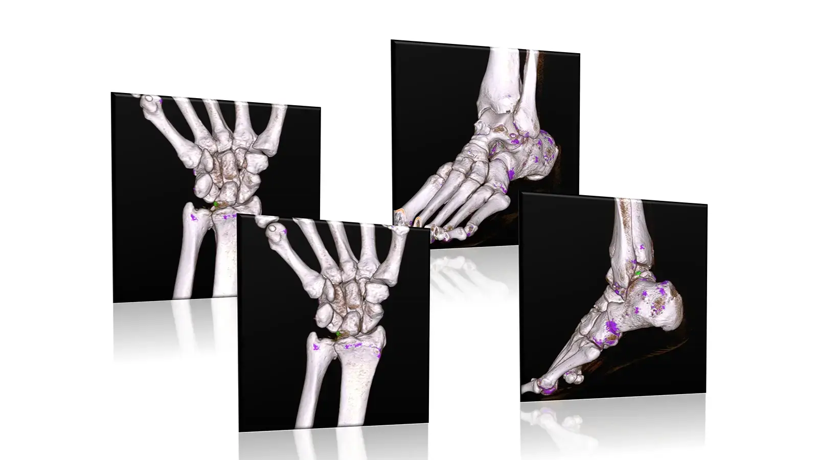 Dual-energy CT scan showing urate crystal deposits associated with gout
