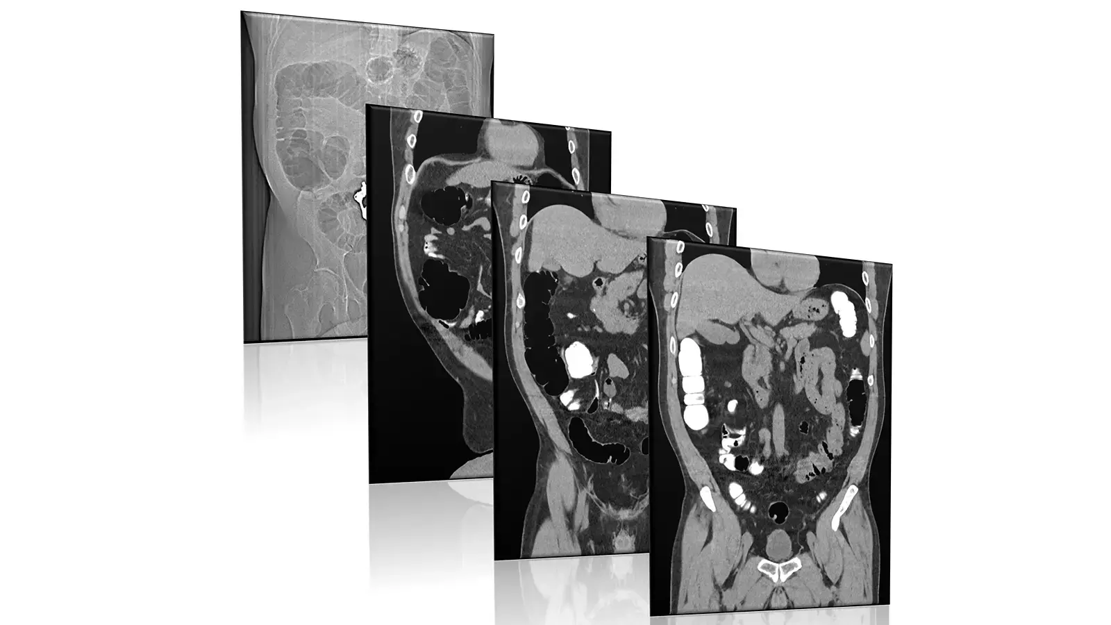 CT scan image of the colon used for virtual colonoscopy