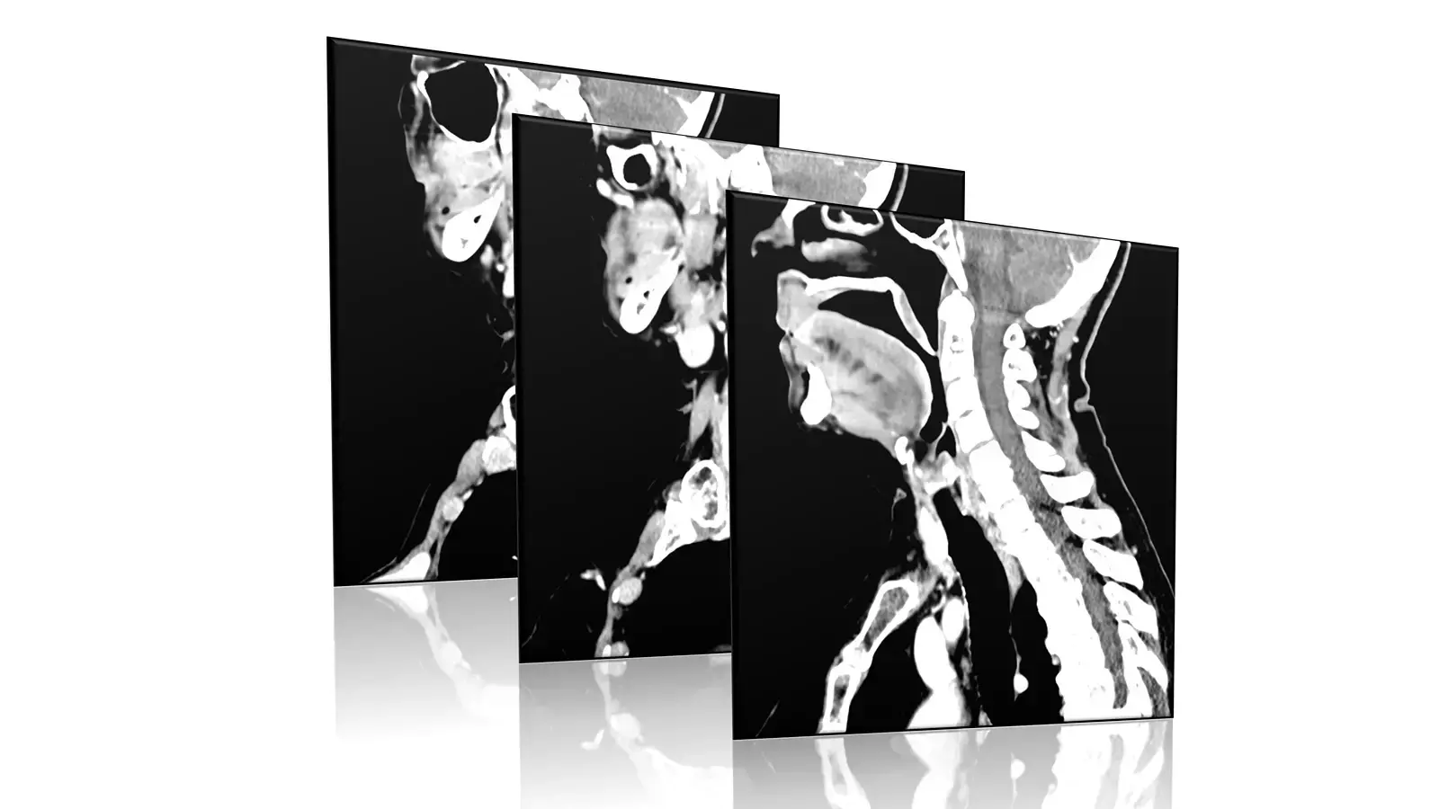 CT cross-sectional image of the thyroid gland and surrounding neck structures