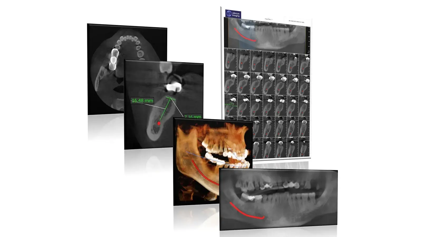 3D cone beam CT scan image of the teeth and jaw