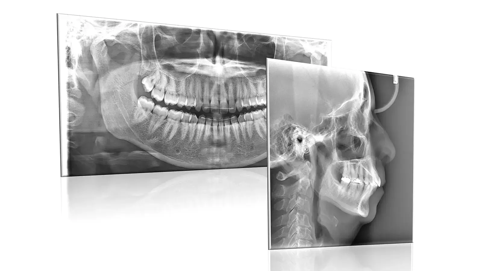 Panoramic dental X-ray showing full jaw and teeth alignment