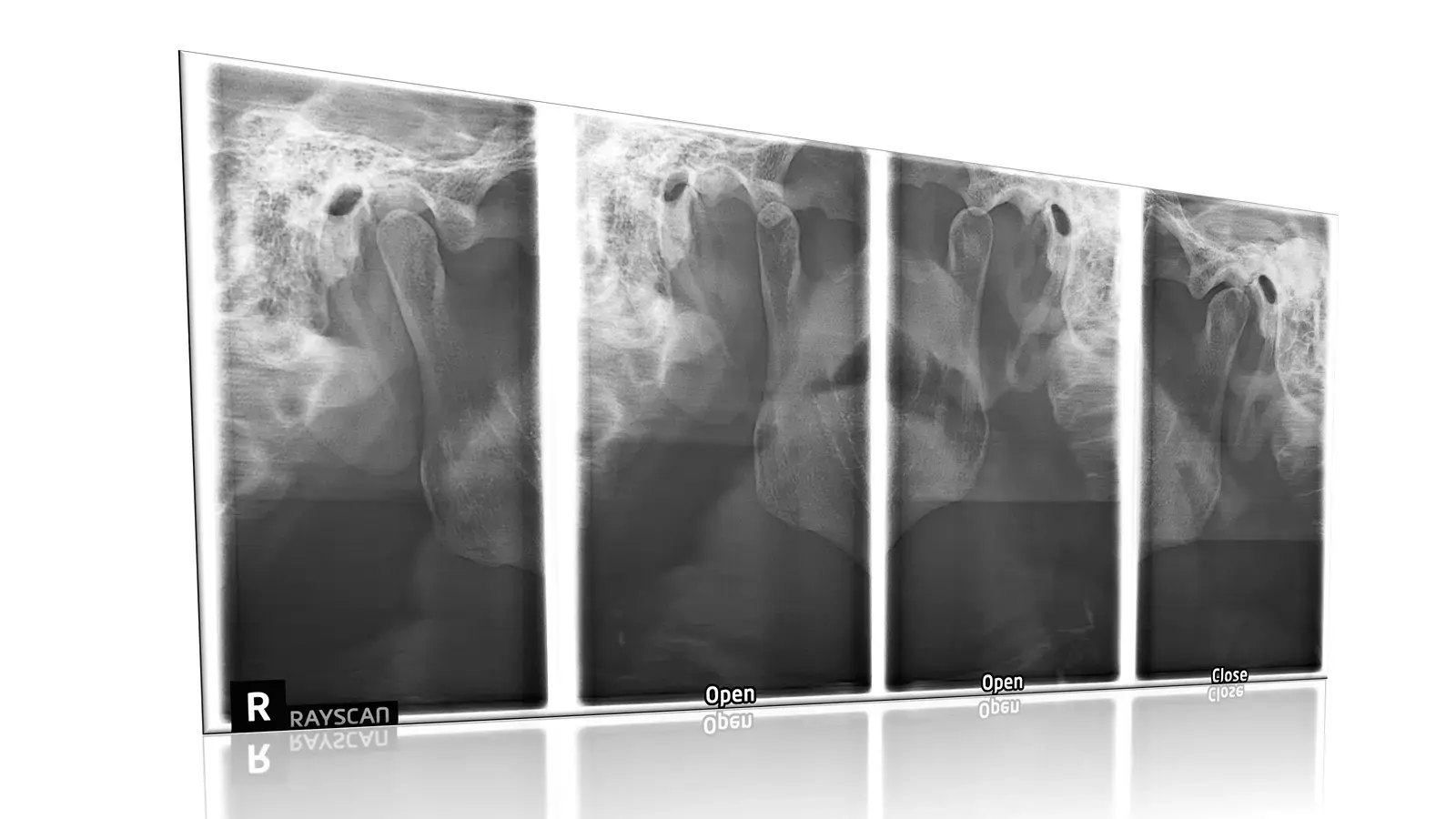 Imaging scan of the jaw joint (temporomandibular joint)