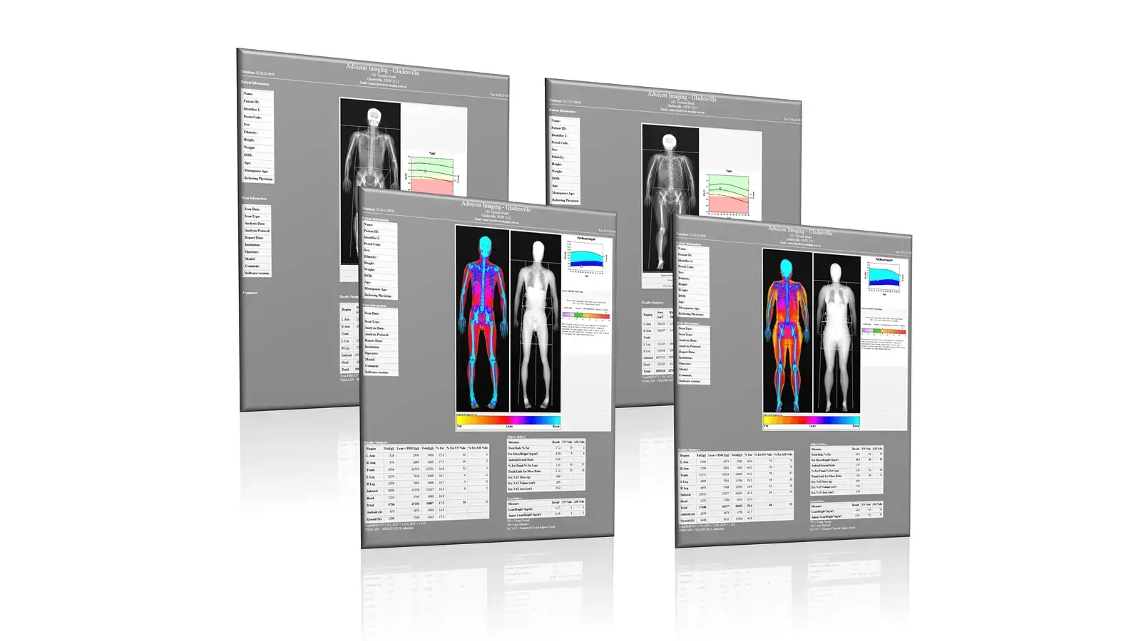 DEXA scan image showing body fat, muscle and bone composition