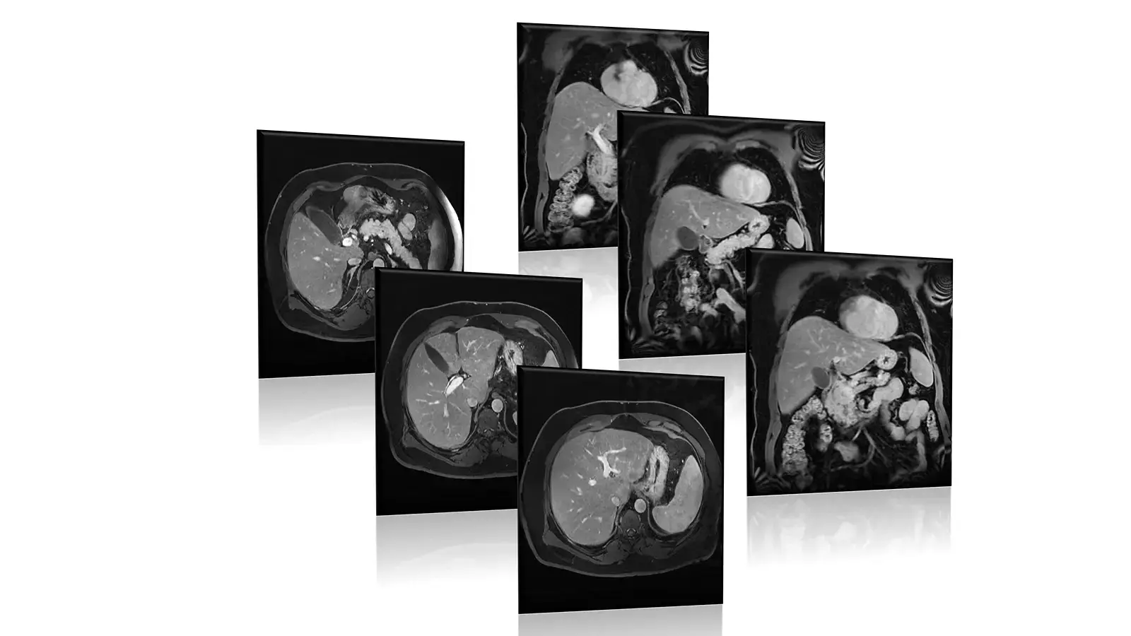 MRCP scan image of the bile ducts and pancreas