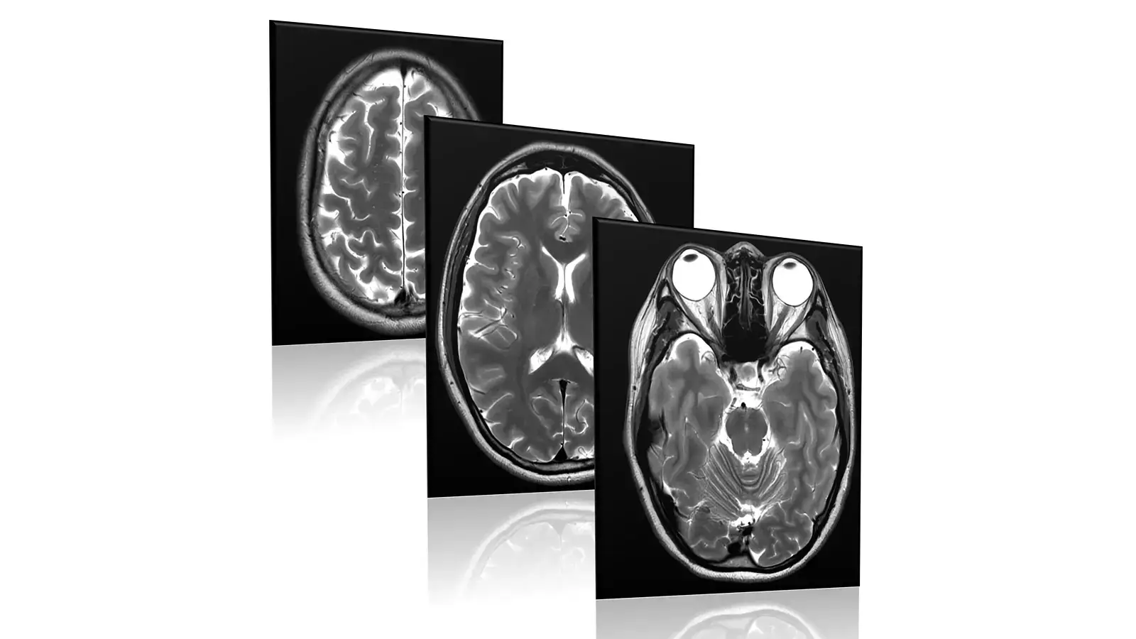 MRI scan cross-section of the brain