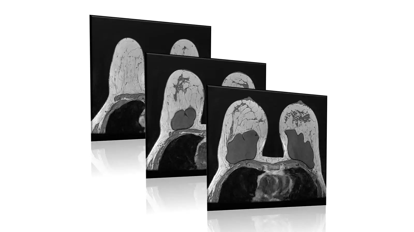 MRI scan image of breast tissue