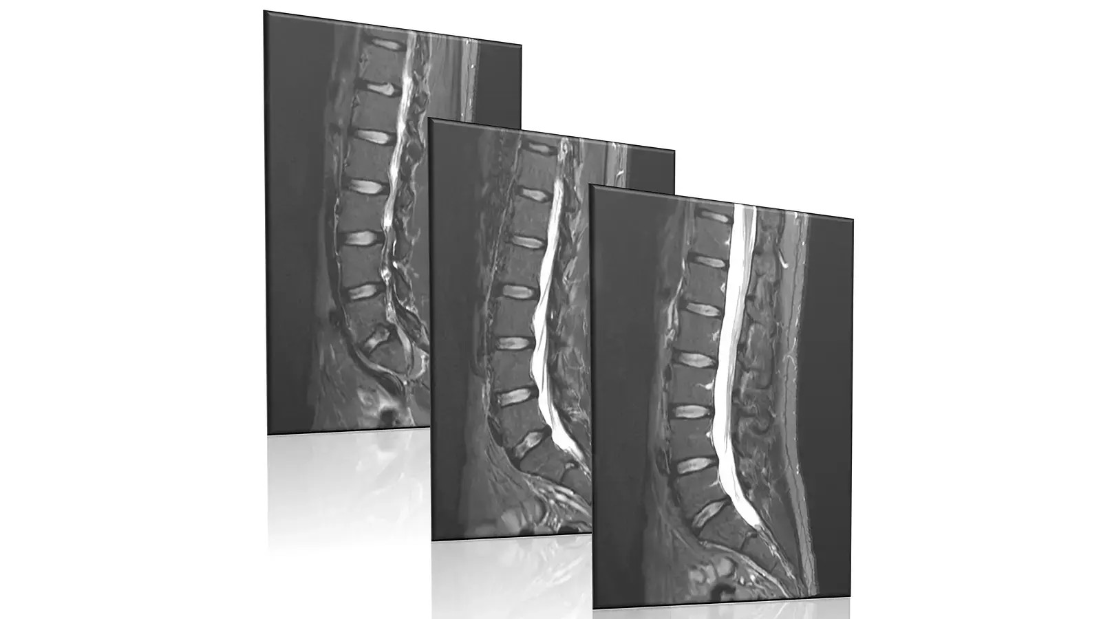 MRI scan cross-section of the lower (lumbar) spine