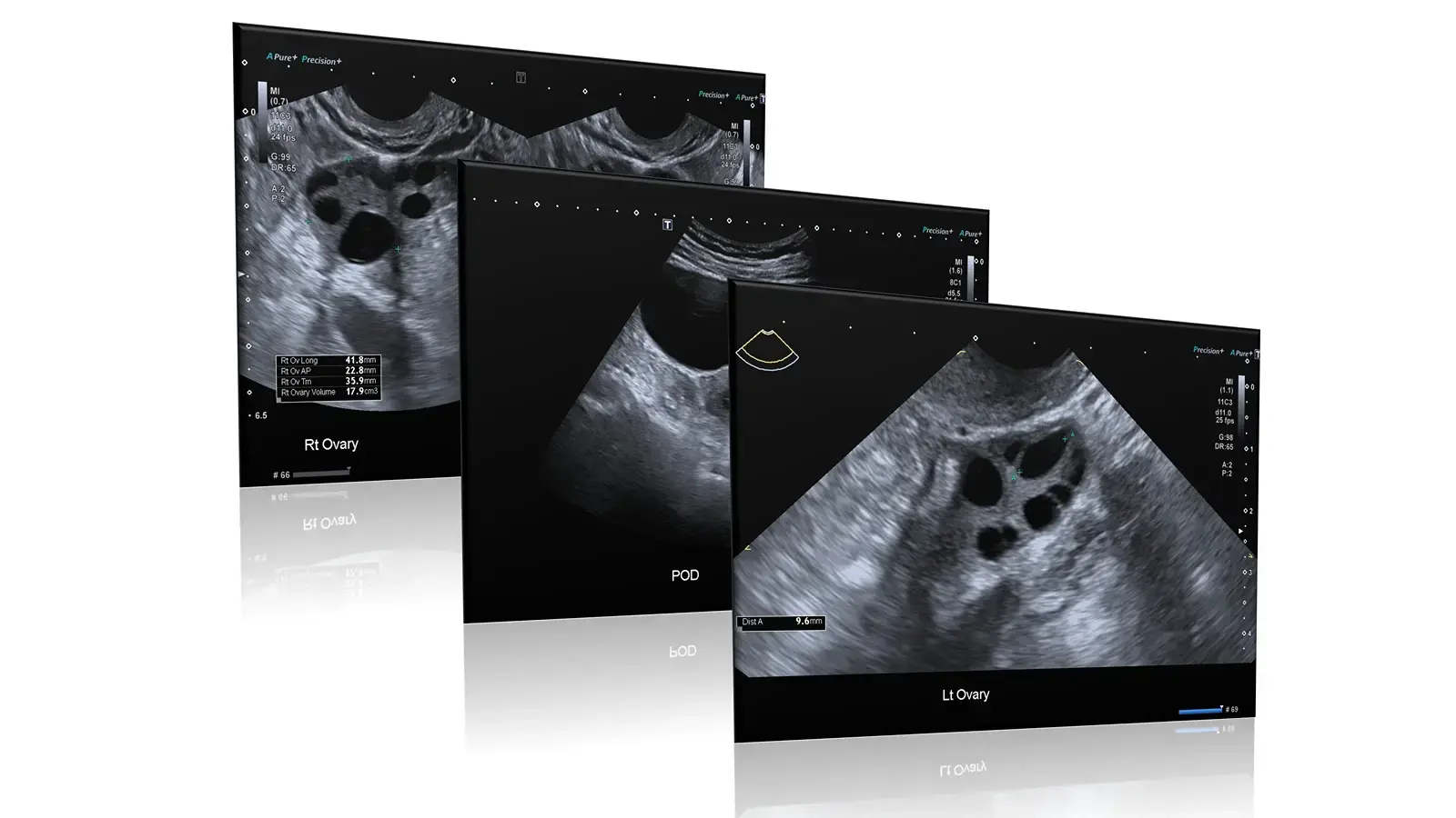 Ultrasound scan image used in women's health imaging